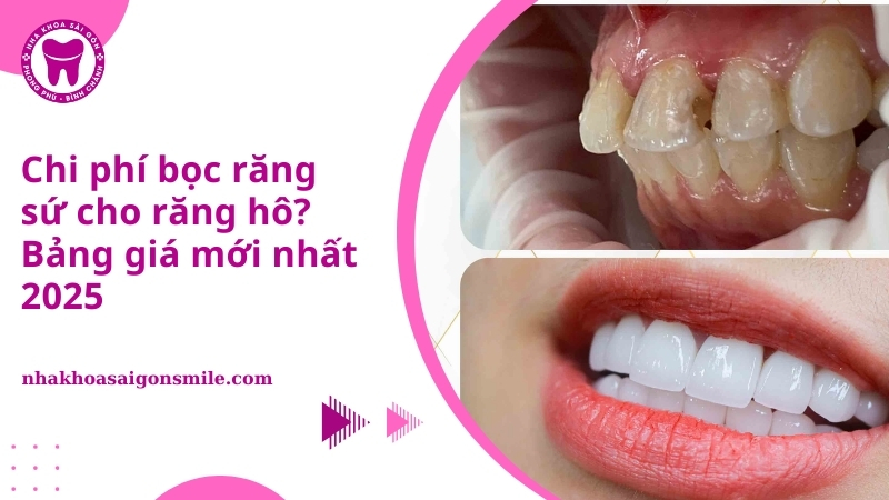 27. Chi phi boc rang su cho rang ho Bang gia moi nhat 2025