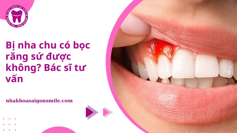 28. Bi nha chu co boc rang su duoc khong Bac si tu van