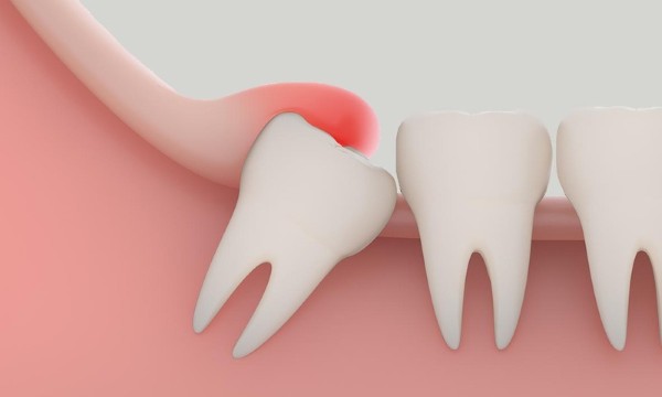 Câu hỏi thường gặp về mọc răng khôn và giảm đau
