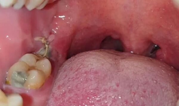 Hướng dẫn chăm sóc và vệ sinh lỗ sau khi nhổ răng khôn tại nhà.