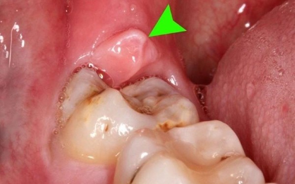 Chẩn đoán và phân biệt viêm lợi trùm răng khôn
