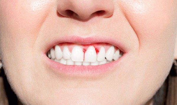 Giải pháp khắc phục lệch khớp cắn sau bọc răng sứ