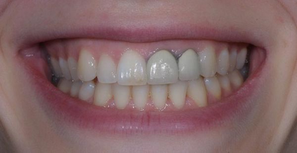 Ảnh hưởng khi bọc răng sứ bị đen nướu