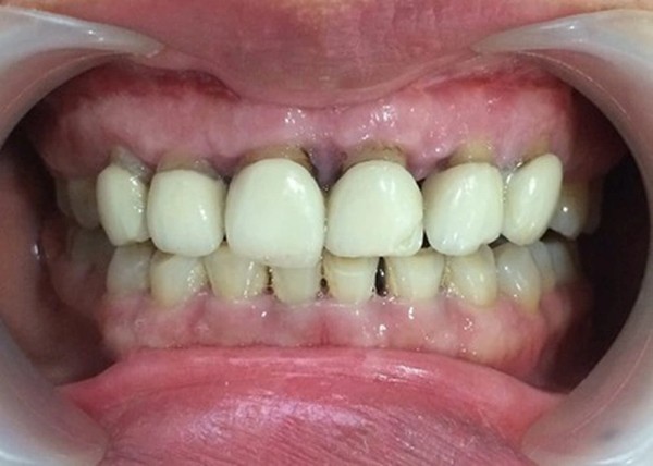 Cách xử lý khi bọc răng sứ bị viêm lợi
