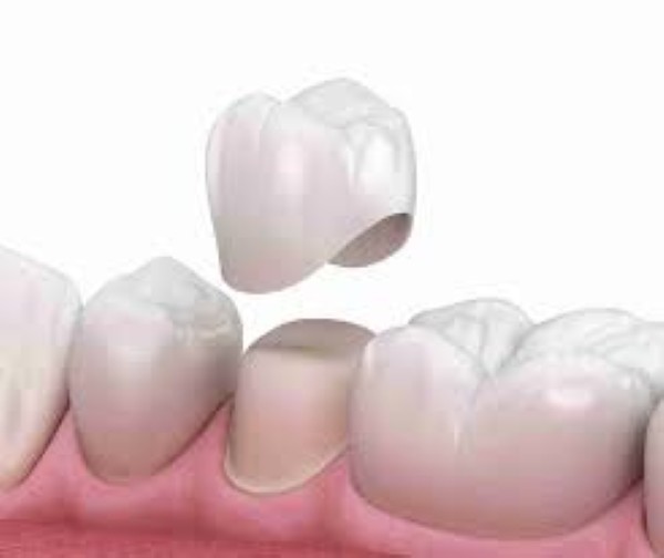 Răng sứ sau khi tháo có tái sử dụng được không?