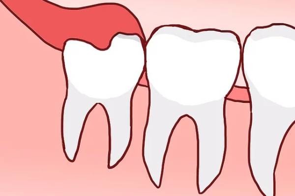 Các trường hợp răng khôn mọc thẳng CẦN cân nhắc nhổ bỏ