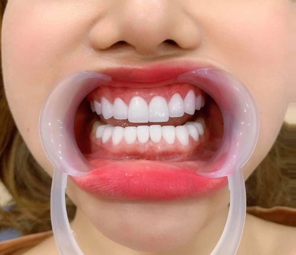 Câu hỏi thường gặp & tư vấn về bọc răng sứ cho răng hô