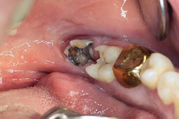 Giải đáp các câu hỏi thường gặp về răng khôn bị sâu