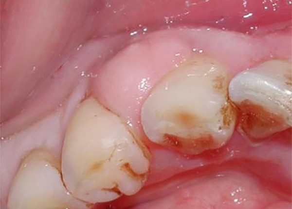 Giải đáp các thắc mắc thường gặp về viêm lợi trùm răng khôn