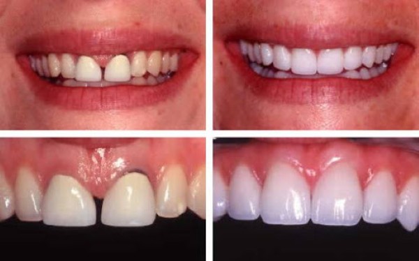So sánh giữa lần bọc răng sứ đầu tiên và lần 2