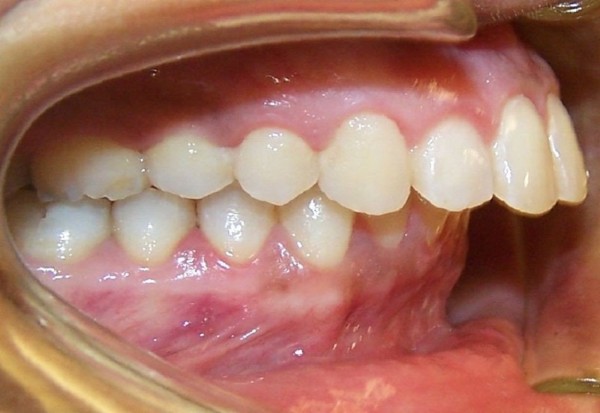 Câu hỏi thường gặp về lệch khớp cắn sau bọc răng sứ