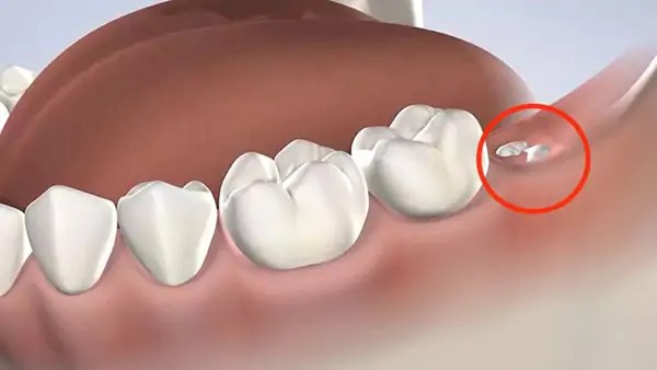 Lợi ích và rủi ro khi nhổ