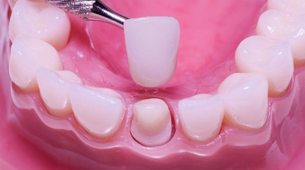 Các câu hỏi thường gặp về tháo răng sứ (FAQ)