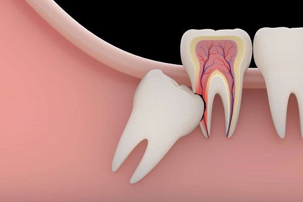 Giải đáp các thắc mắc thường gặp về chi phí nhổ răng khôn và bảo hiểm y tế