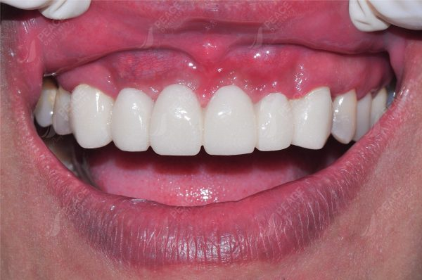 Câu hỏi thường gặp về bọc răng sứ bị viêm lợi