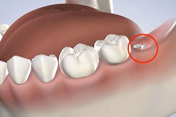 Phòng ngừa biến chứng và giải đáp thắc mắc
