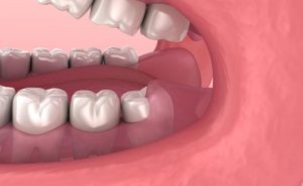 Quy trình đánh giá xác định có nên nhổ răng khôn mọc thẳng không?