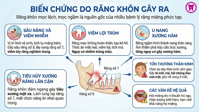 Biến chứng do răng khôn gây ra Biến chứng do răng khôn gây ra