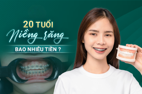 20 Tuổi niềng răng bao nhiêu tiền? Bảng giá chi tiết tại Nha khoa Sài Gòn