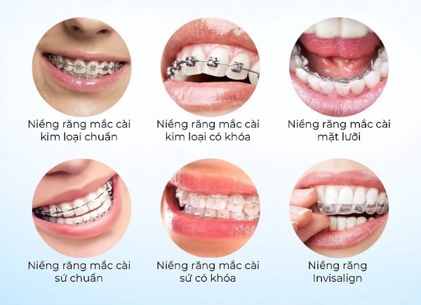 Các phương pháp niềng răng phổ biến nhất hiện nay