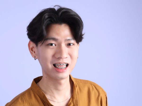 Phương pháp niềng răng cho người 20 tuổi