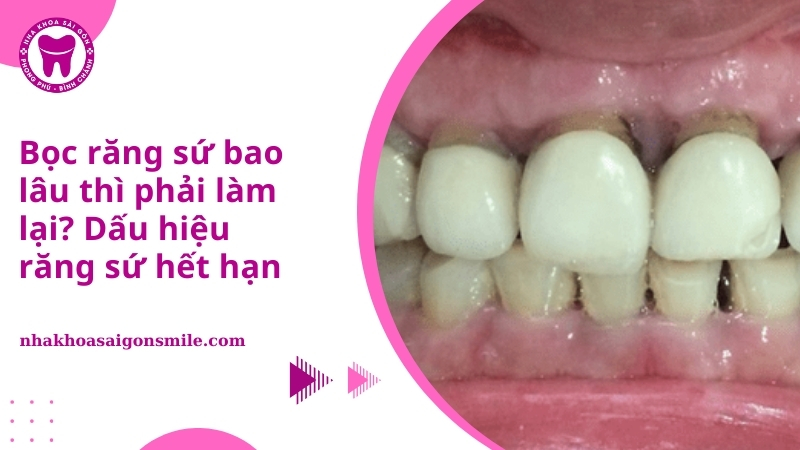 Bọc răng sứ bao lâu thì phải làm lại
