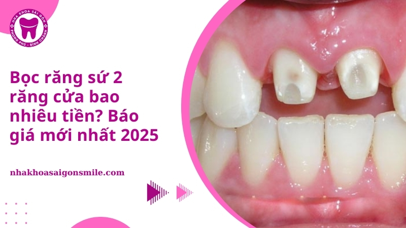 Bọc răng sứ 2 răng cửa bao nhiêu tiền