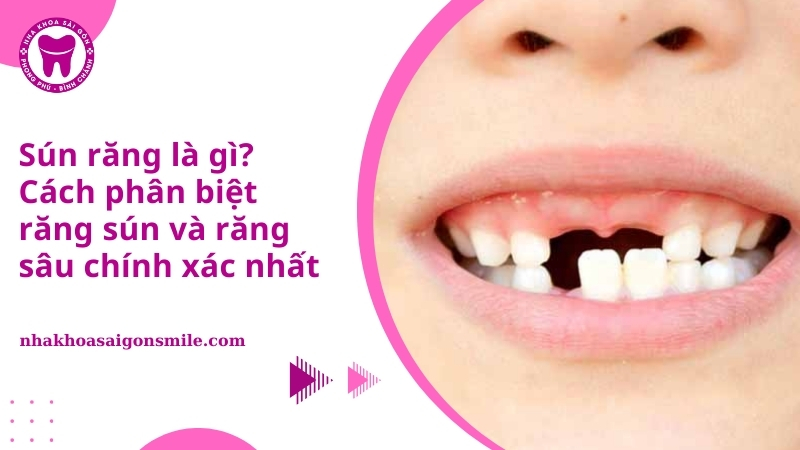 Sún răng là gì? Cách phân biệt răng sún và răng sâu chính xác nhất
