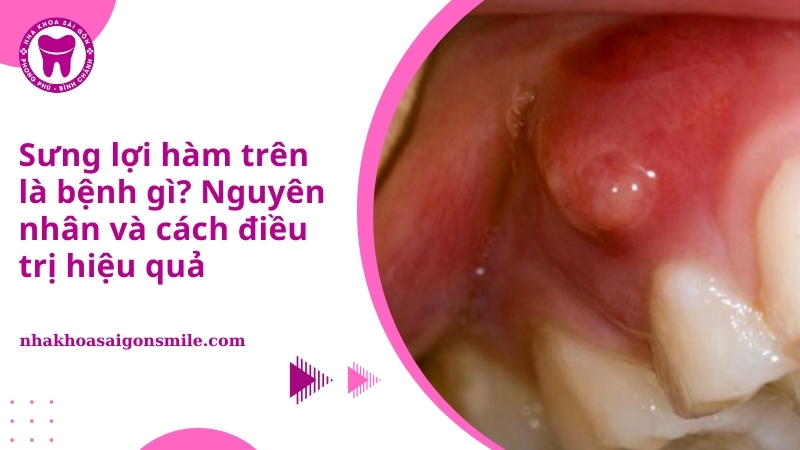 Sưng lợi hàm trên
