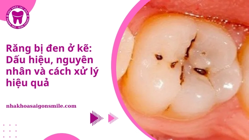răng bị đen ở kẽ