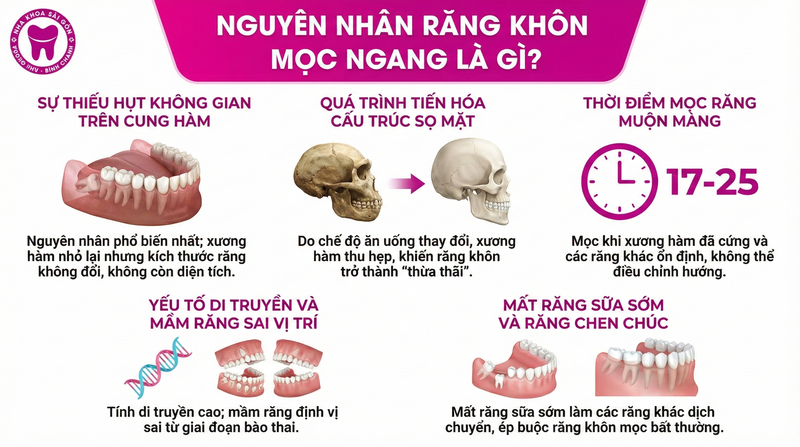 Nguyên nhân răng khôn mọc ngang là gì? Nguyên nhân răng khôn mọc ngang là gì?
