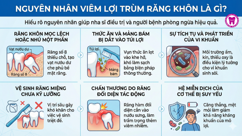 Nguyên nhân viêm lợi trùm răng khôn là gì? Nguyên nhân viêm lợi trùm răng khôn là gì?