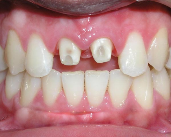 Tổng quan về bọc răng sứ cho 2 răng cửa
