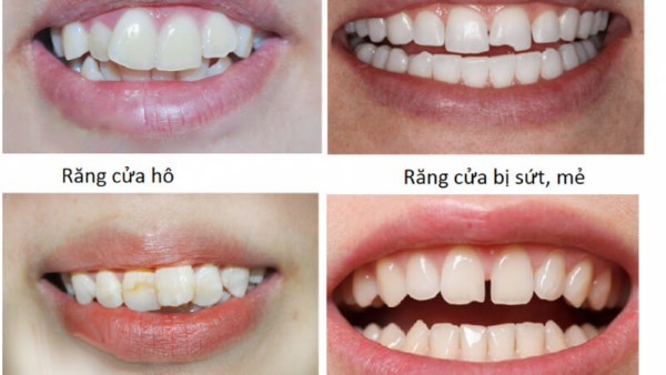 Trường hợp nào nên bọc răng sứ 2 răng cửa?