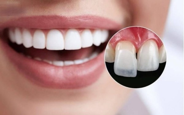 Bọc răng sứ 2 răng cửa bao nhiêu tiền?