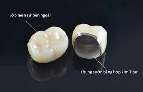 Răng sứ kim loại thường, Titan