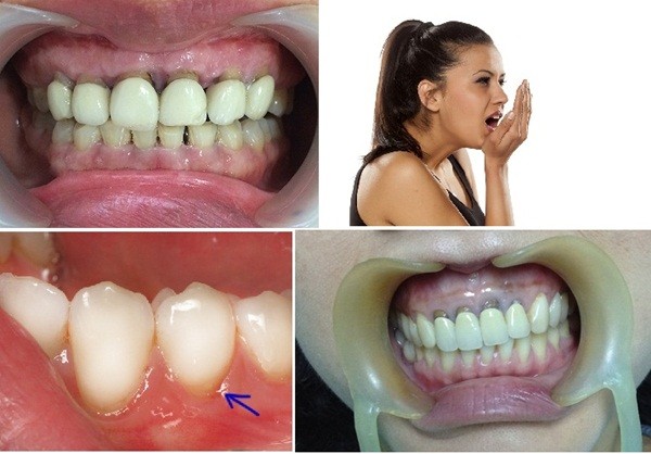 Hướng dẫn nhận biết và phòng tránh dịch vụ bọc răng sứ kém chất lượng