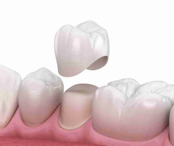 Tổng quan về phương pháp bọc răng sứ tại Nha khoa Sài Gòn