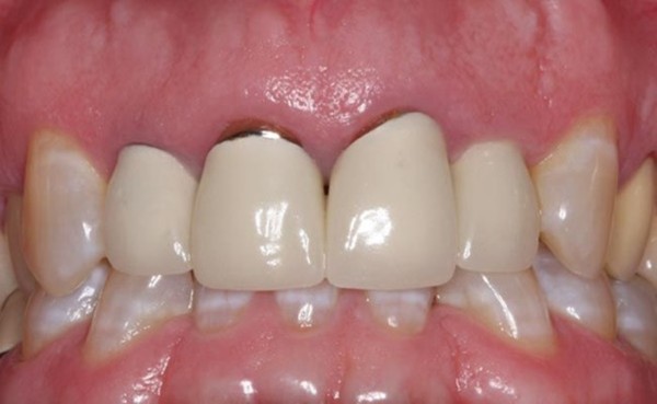 Cách xử lý khi răng sứ hết hạn