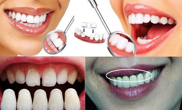 Cách khắc phục tình trạng hôi miệng sau khi bọc răng sứ