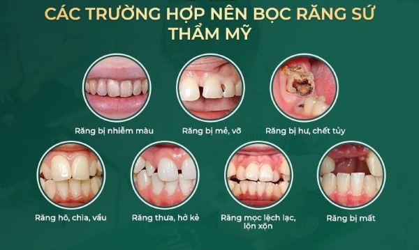 Có nên bọc răng sứ không và những ai nên thực hiện?