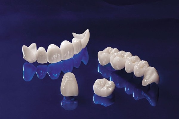 Tổng quan về bọc răng sứ giá bao nhiêu tại Việt Nam