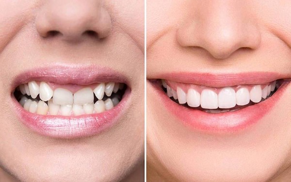 Lựa chọn phù hợp với từng ngân sách