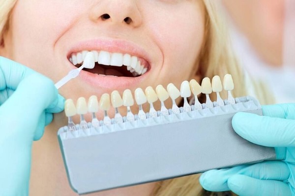 Tổng quan về bọc răng sứ không mài