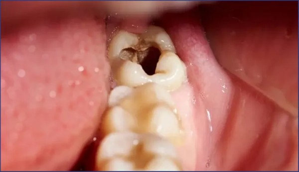 Nhức răng có lỗ là gì? 