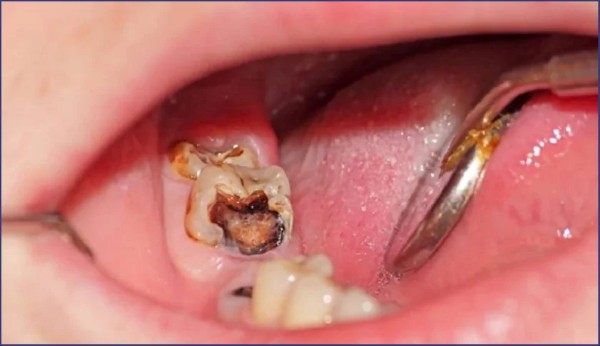 Cách trị nhức răng có lỗ do sâu răng hiệu quả