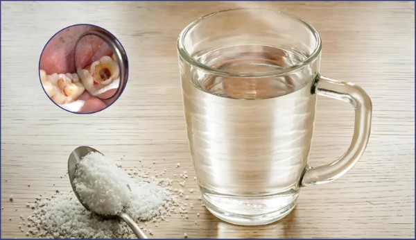 Súc miệng bằng nước muối – Cách trị nhức răng có lỗ đơn giản