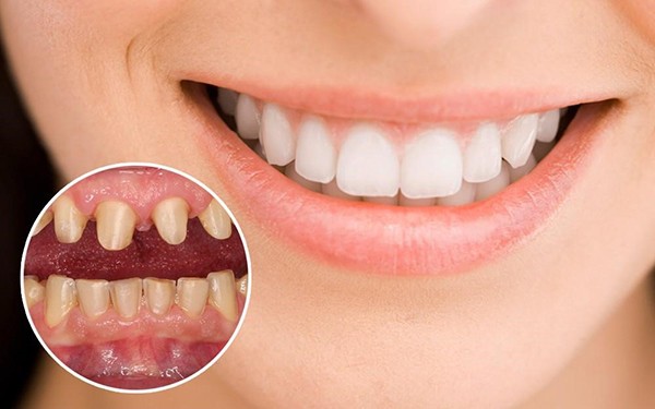 Có nên bọc răng sứ không?
