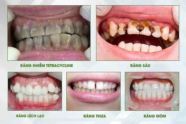 Những vấn đề về thẩm mỹ khi bọc răng sứ