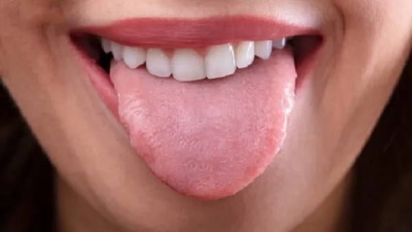 Hình ảnh viêm gai lưỡi giai đoạn đầu (giai đoạn nhẹ)